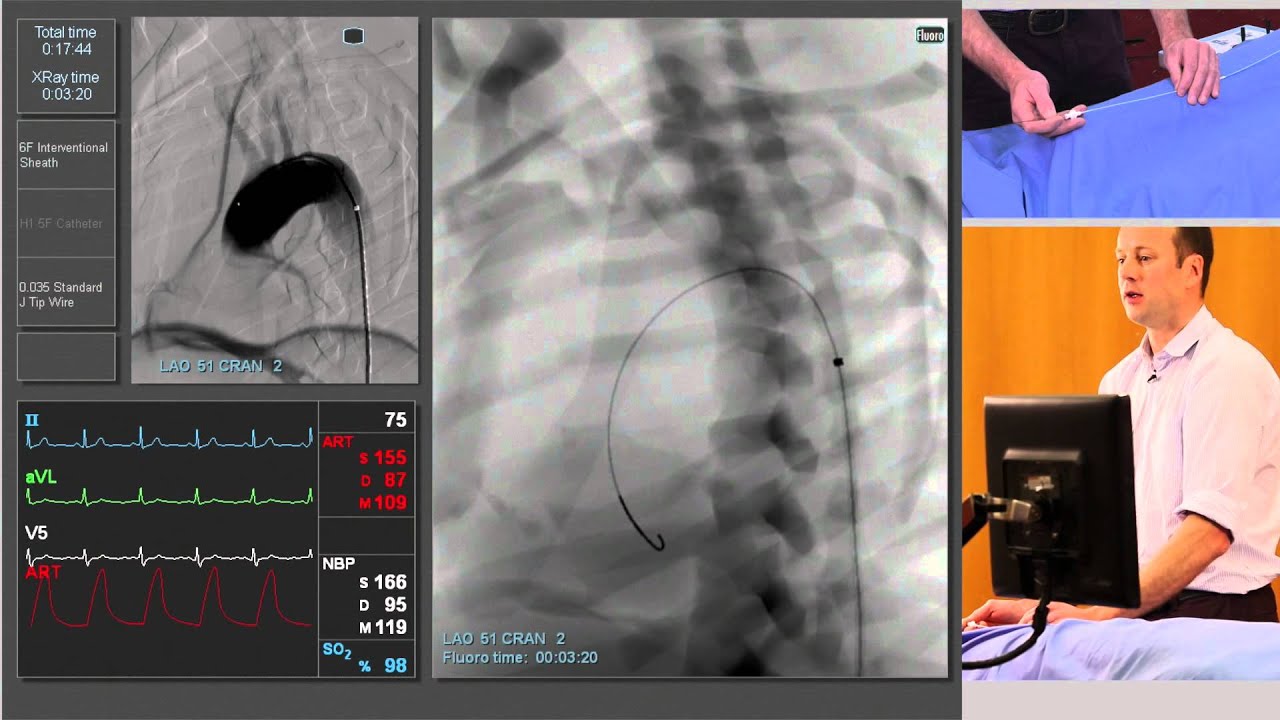 Arch Aortography