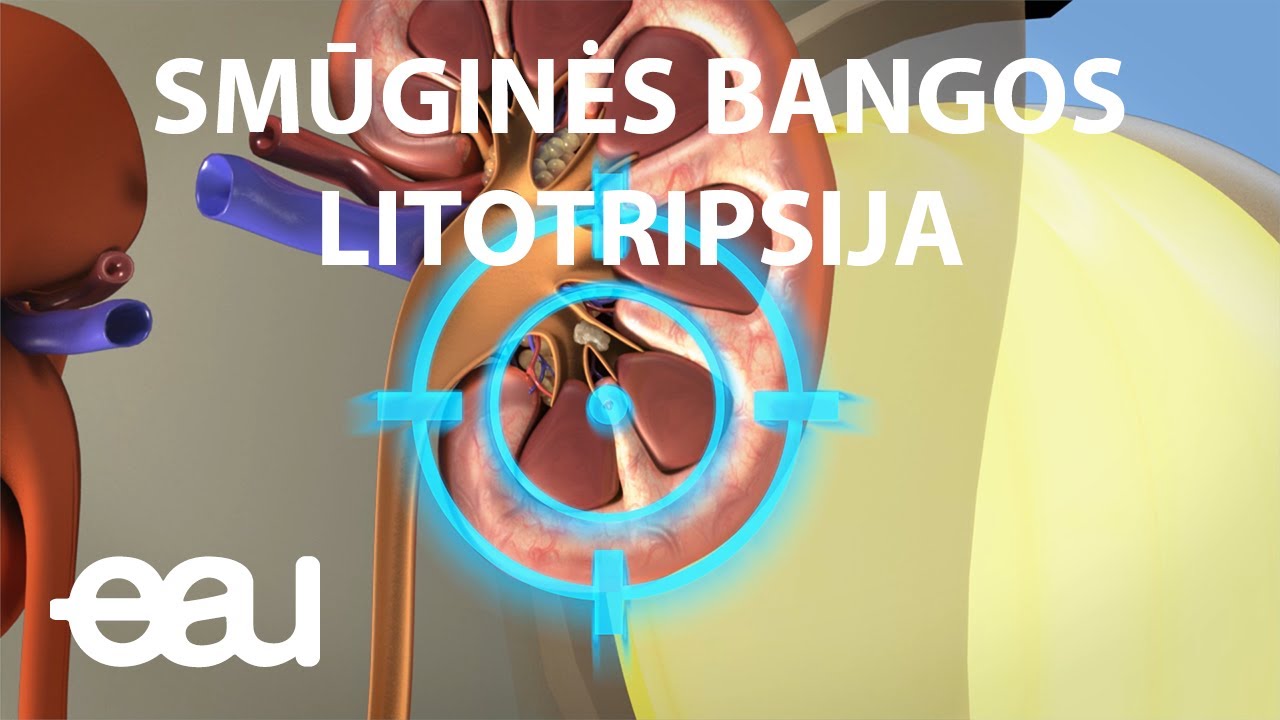 SMŪGINĖS BANGOS LITOTRIPSIJA  (SWL Lithuanian)