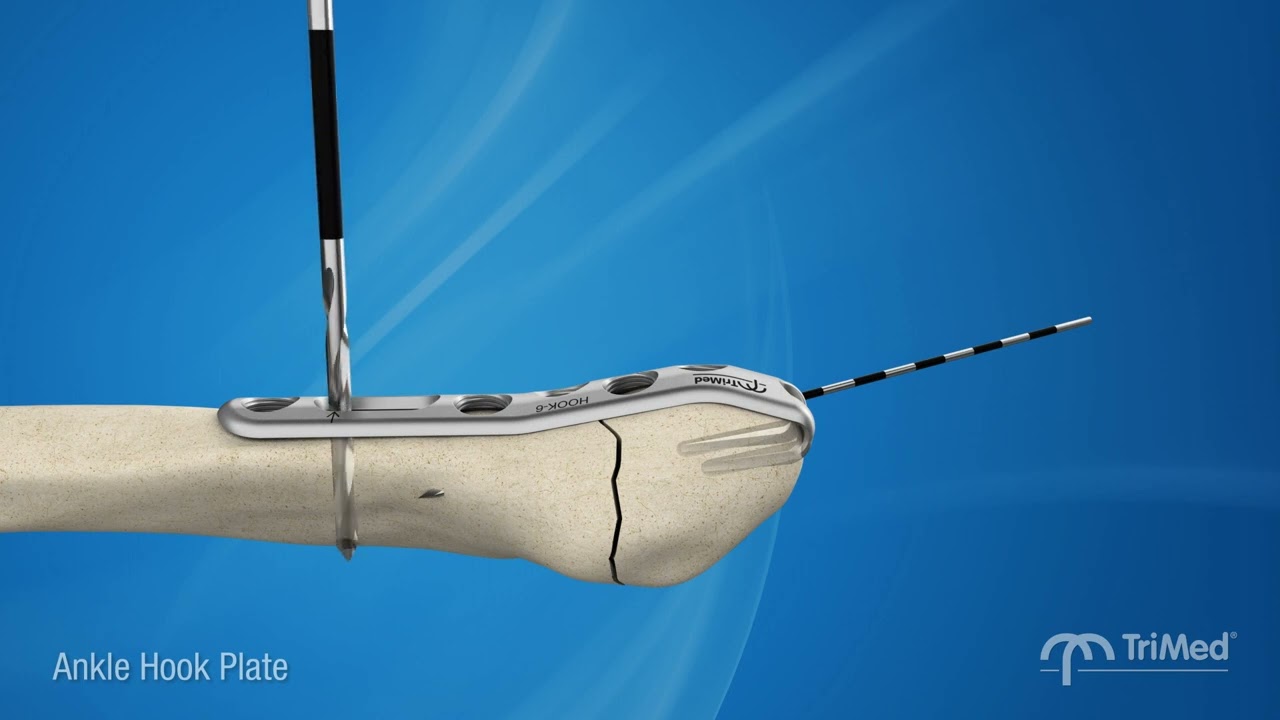 Weber A fracture care - Treating lateral malleolus fractures with TriMed Ankle Hook Plate