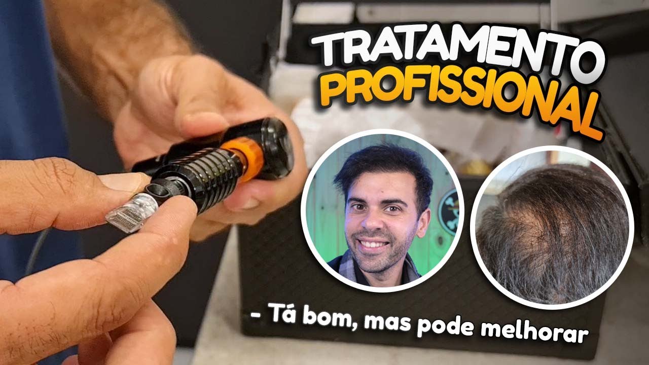Queda de cabelo masculino com MMP (Micro infusão de Medicamentos pela Pele), funciona?