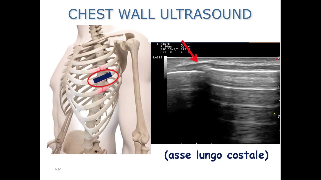 Lung US: ribs fractures