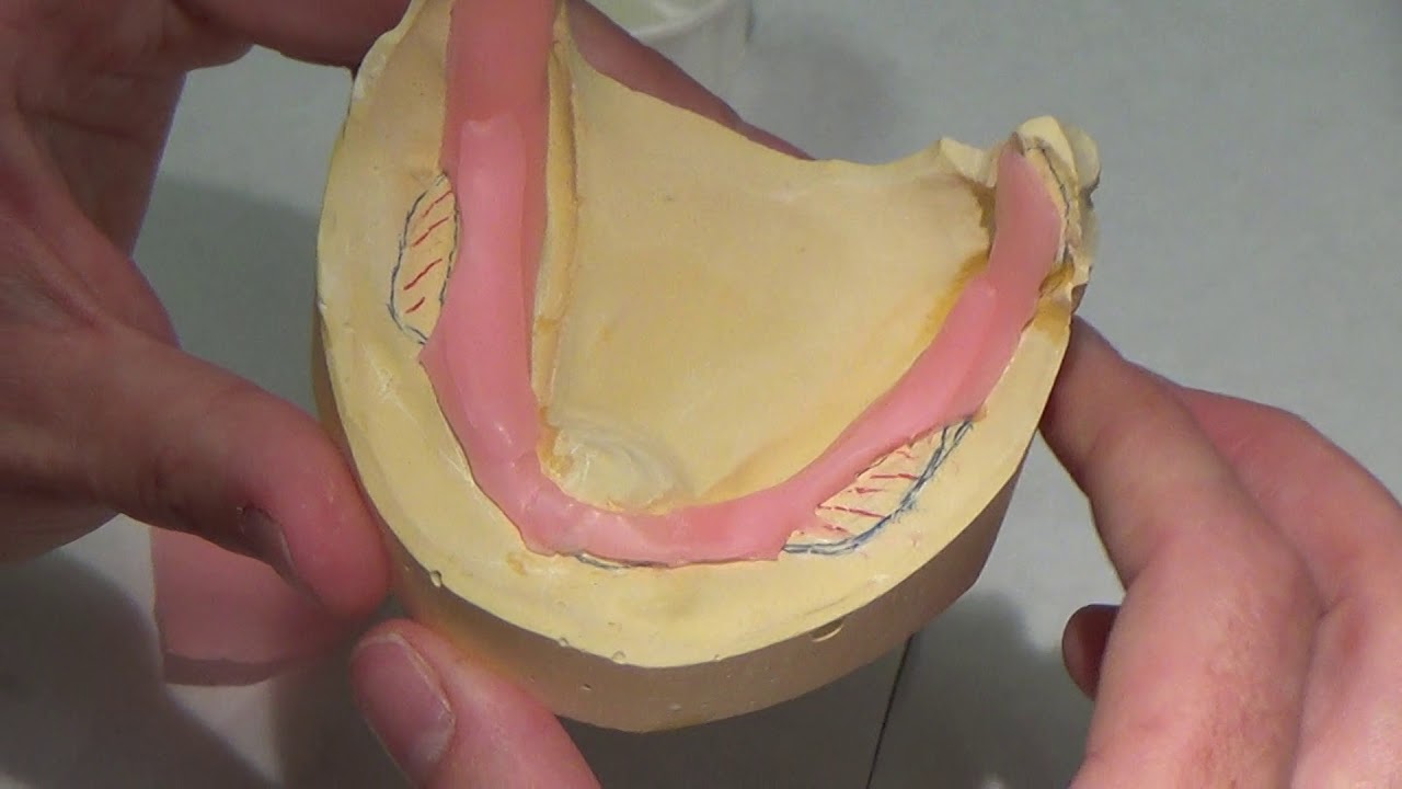 Edentulous Mandibular Custom Tray (Patient) Part 2