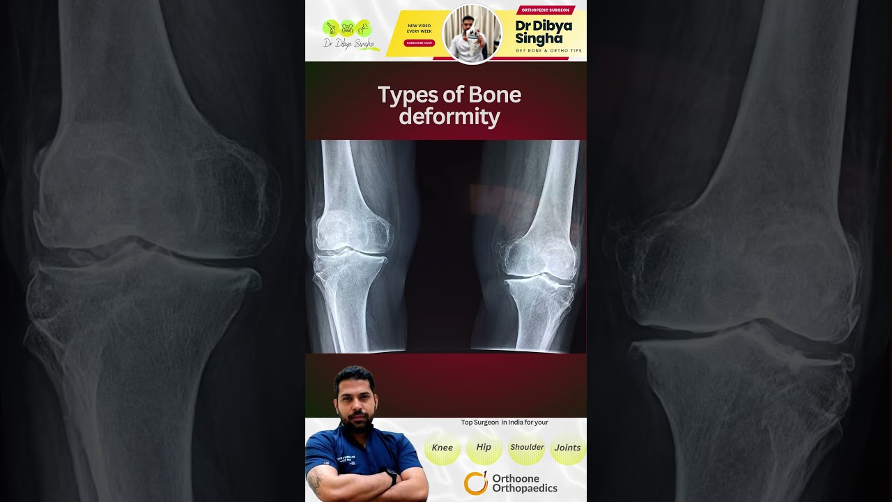 Bone deformity types by Dr Dibya Singha  #bhubaneswar #bonedeformity #trending #viralshorts