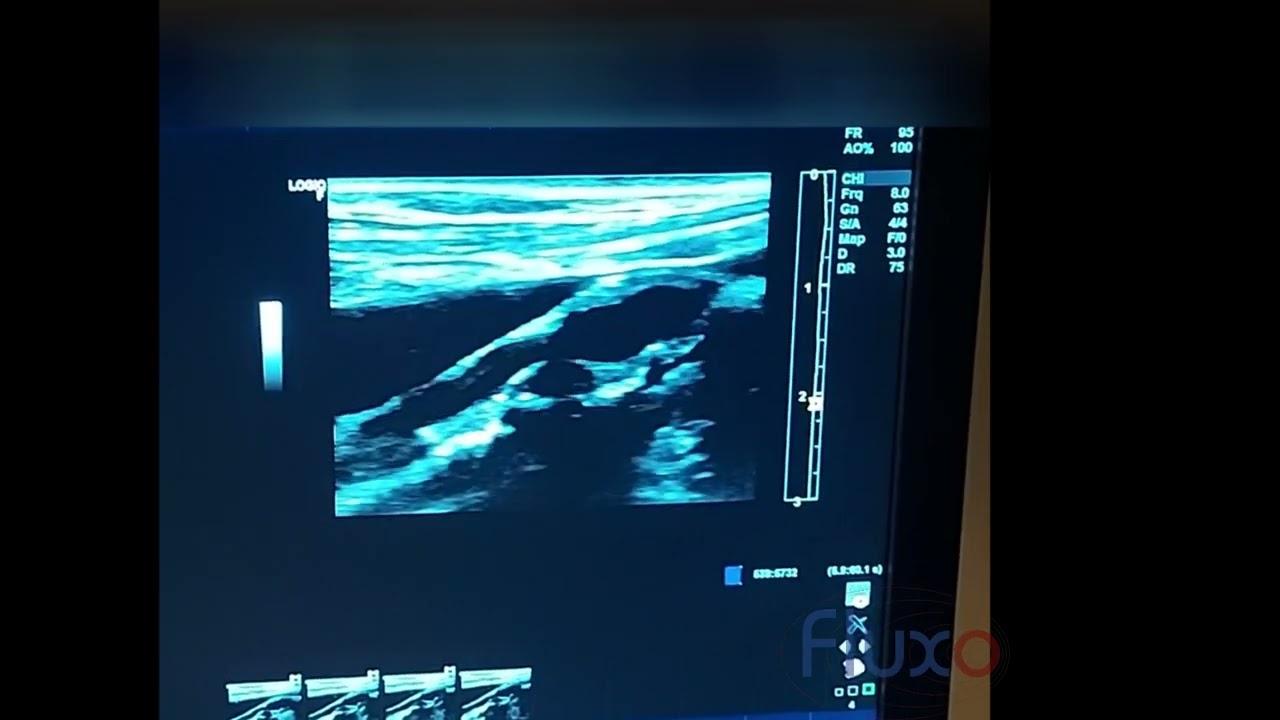 Doppler de Car&oacute;tida - Estenose maior que 70% com placa inst&aacute;vel com core hipoecoico.