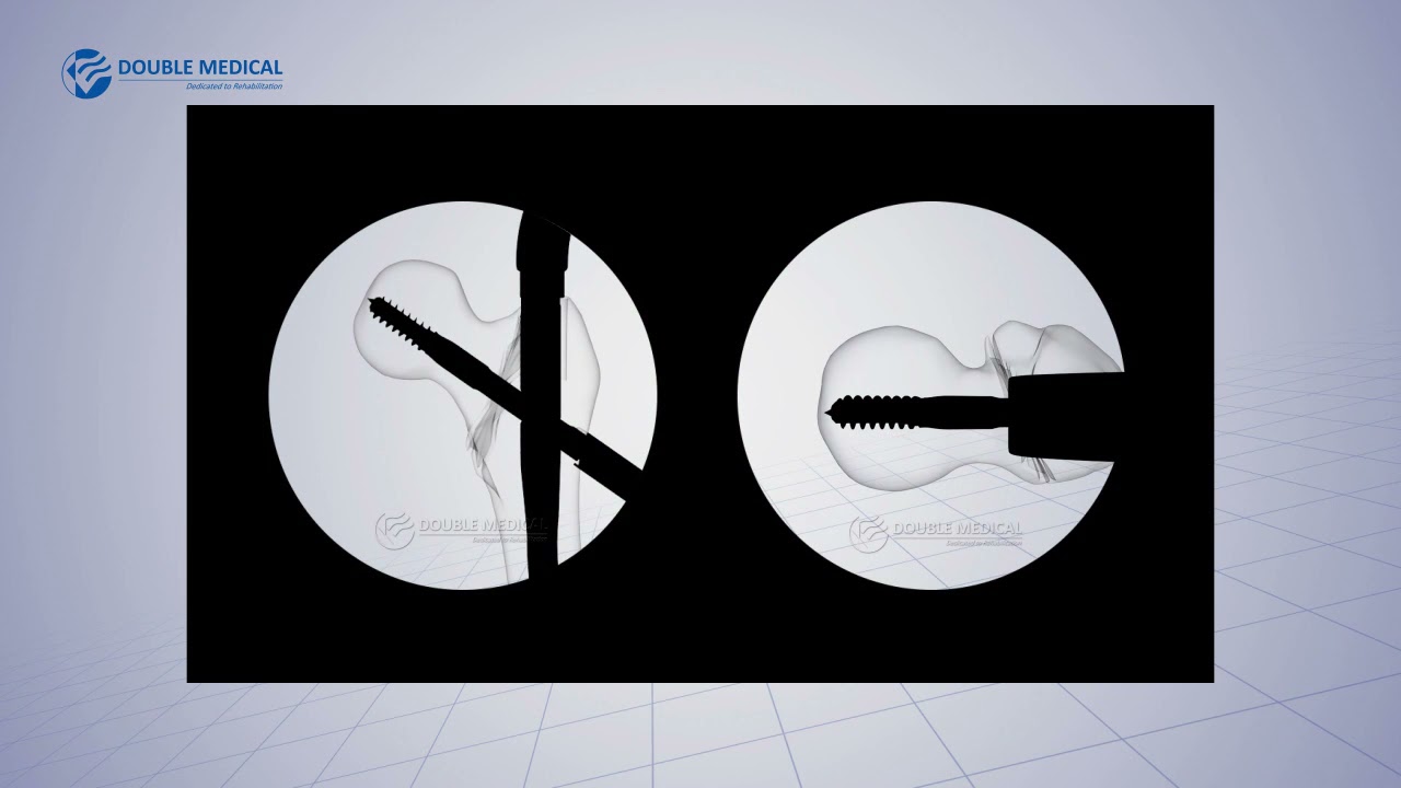 APFN Lag Screw Insertion
