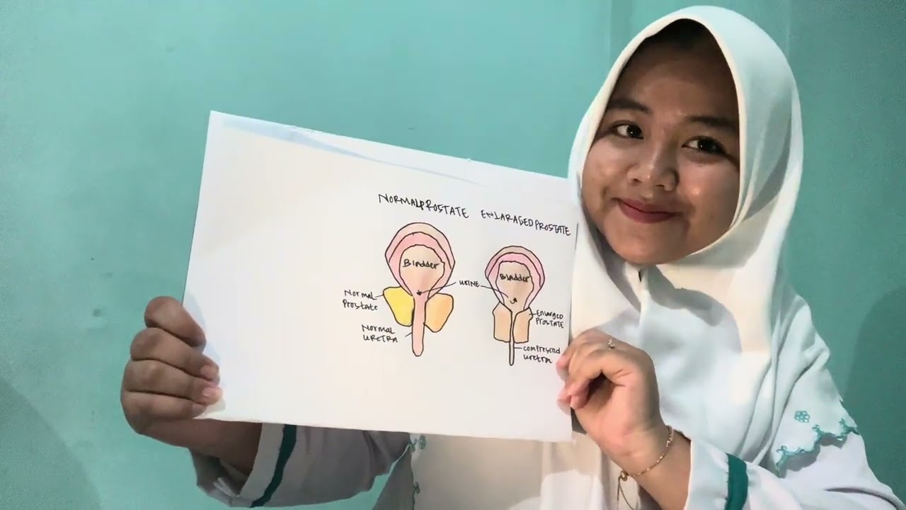 Tugas Menggambar dan Beradaptasi dengan sel BPH Normal dan Abnormal 