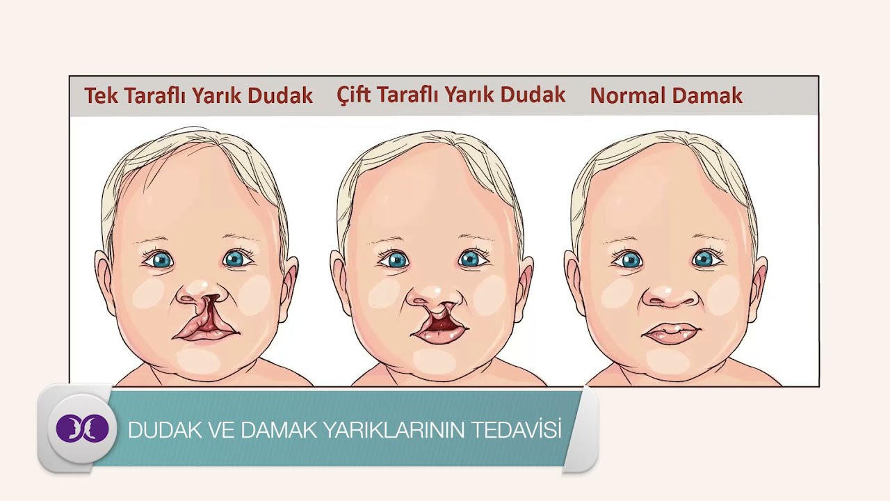 Dr. Ahmet Torkut - Dudak ve Damak Yarıklarının Tedavisi
