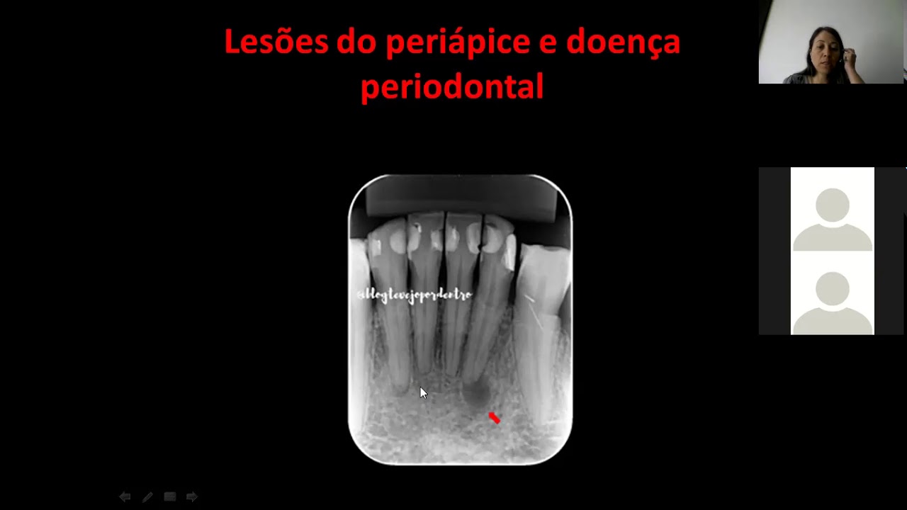 AULA PRÁTICA DE LESÕES DO PERIÁPICE E DOENÇA PERIODONTAL parte 01