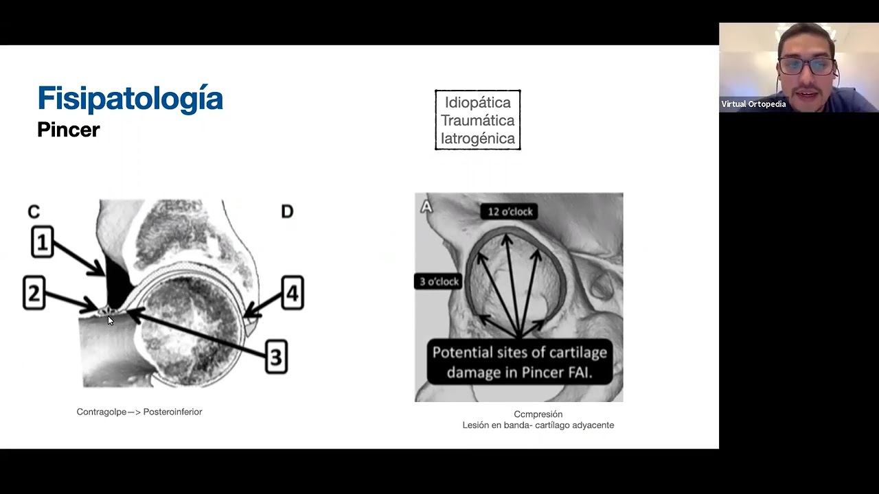 Pinzamiento femoroacetabular