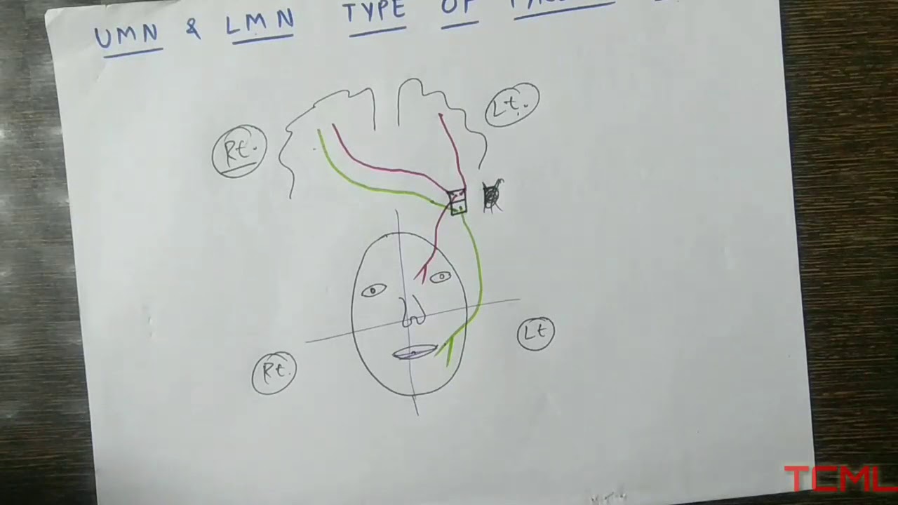 Upper and lower motor neuron type of facial palsy