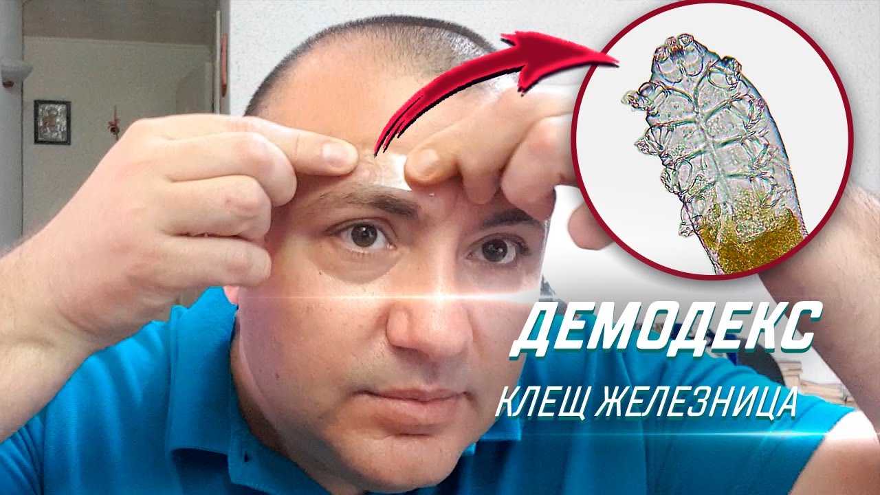Мелкий паразит живет в коже каждого человека - Угревая Железница (Demodex)