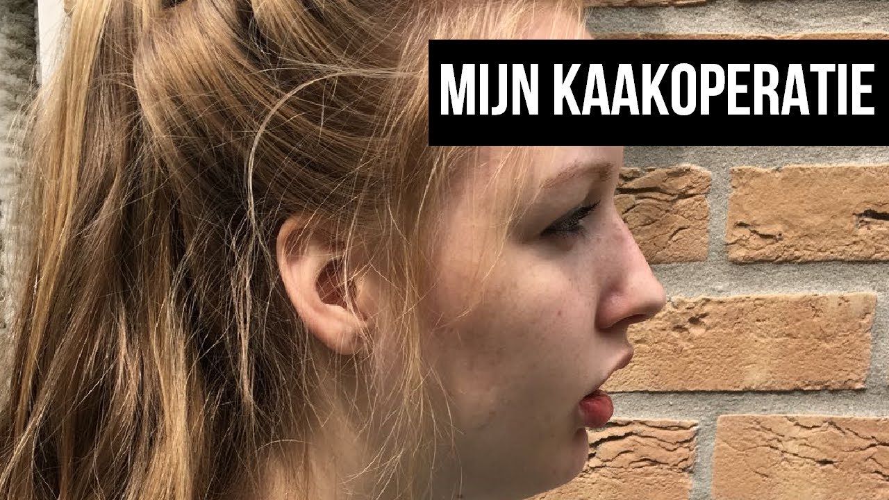 MIJN DUBBELE KAAKOPERATIE! [OVERBEET]