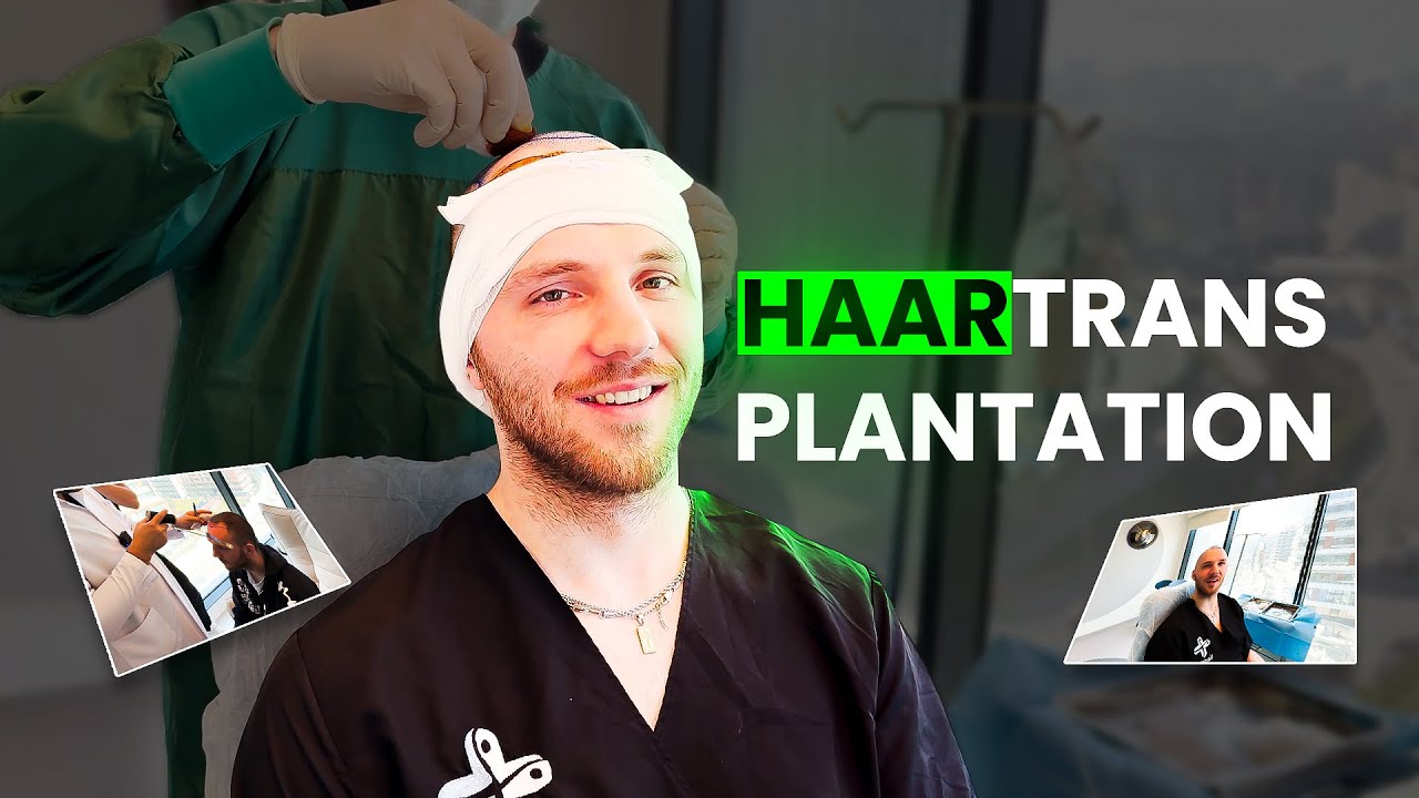 HAARTRANSPLANTATION IN DER TÜRKEI! | Endlich keine Geheimratsecken mehr 🔥😍