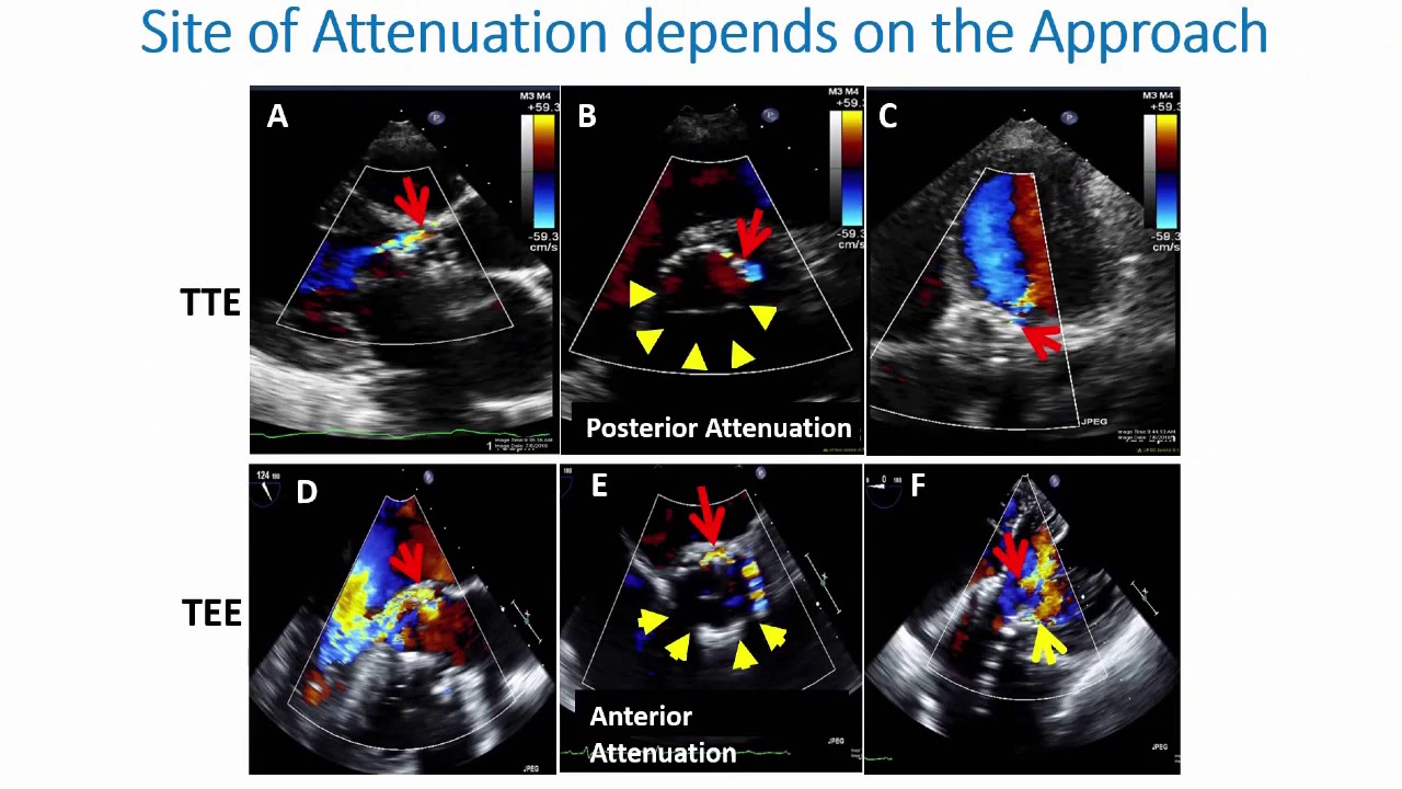 Webinar On Evaluation of Valve Regurgitation after Percutaneous Valve Replacement