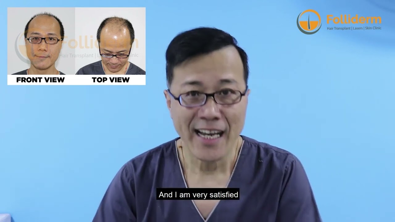 Hair Transplant in Nepal | Mr. Lam's Testimonial from China