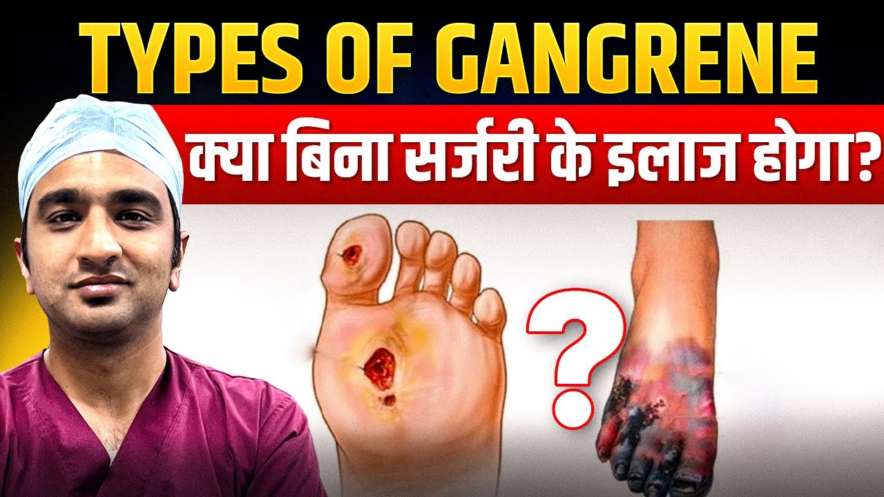 पैर काला पड़ने की वजह Gangrene तो नहीं? | What is Gangrene & It's Type | Treatment Without Surgery