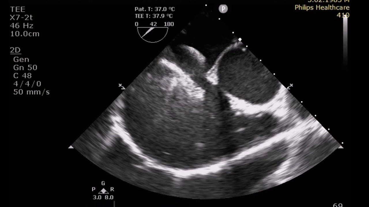 TRANSCATHETER CLOSURE OF MUSCULAR VSD  AND MULTIPLE ASD IN AN ADULT: ECHO IMAGES