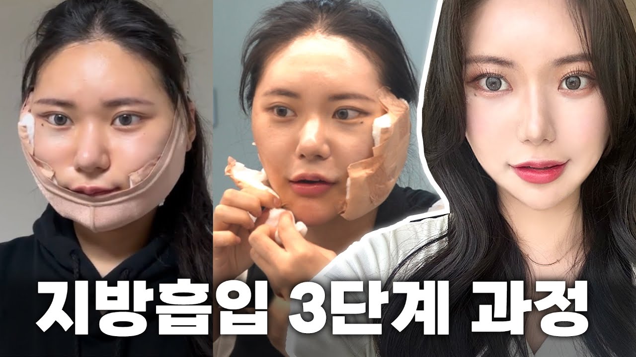 [스튜어디스혜정아 Vlog] 얼굴지방흡입 효과 장난아니네요🙄 양약으로도 안빠지던 얼굴살 완전 쏙  빠졌어요