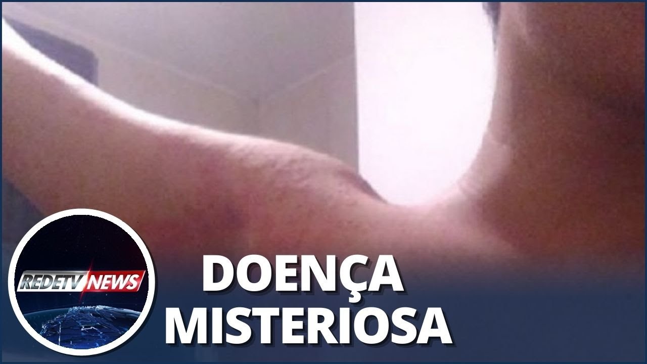 Pernambuco: surto de coceira e mancha na pele preocupa moradores; 200 casos j&aacute; foram registrados
