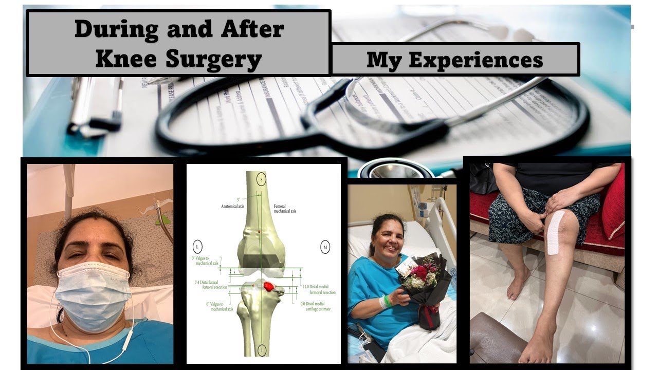 #MyPostKneeSurgeryExperiences #Physiotherapy #kneeReplacement #KneeSurgery #premascooktop #vlog