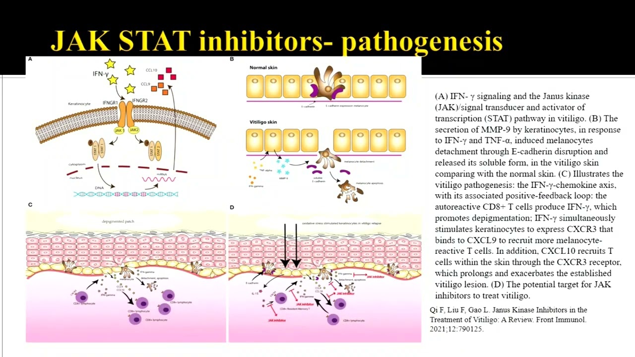 Immunosuppressive Therapy in Vitiligo : An Update