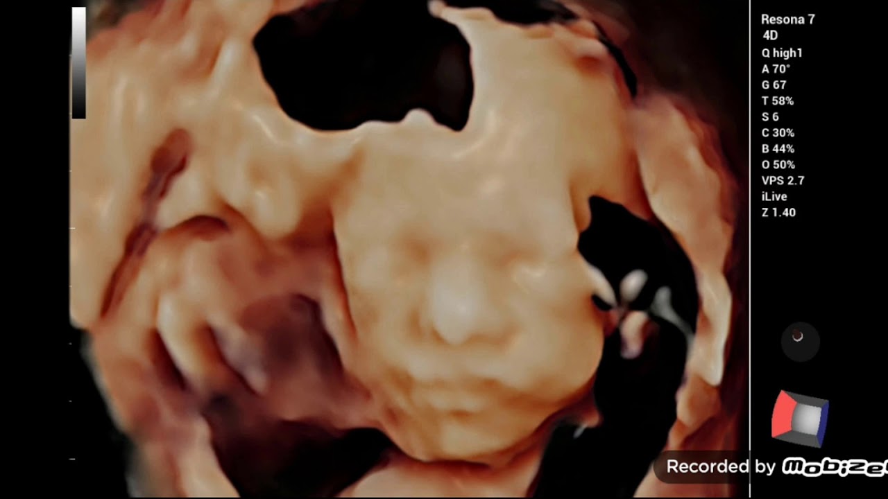 5D ULTRASOUND ROCK
