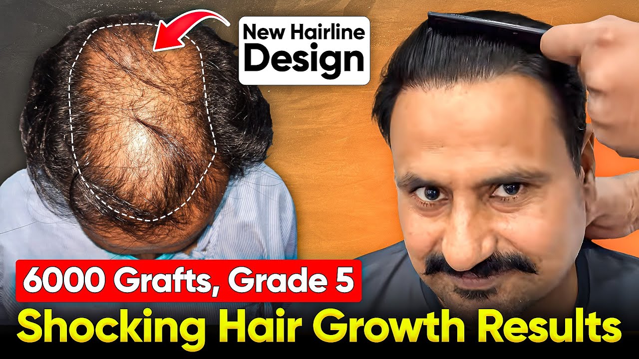 Grade 6 Hair Transplant Before and After Results - Best Hair Transplant Doctor in India #hair