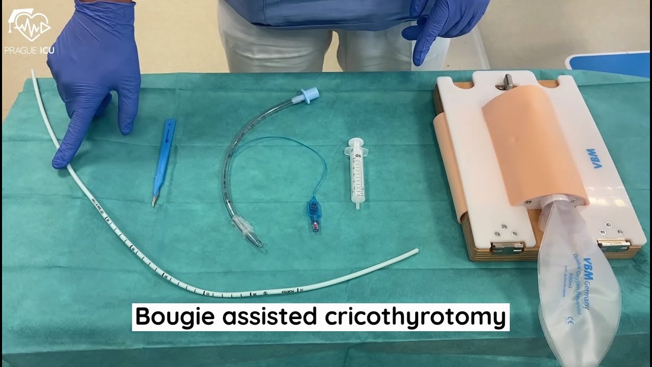 Bougie assisted cricothyrotomy