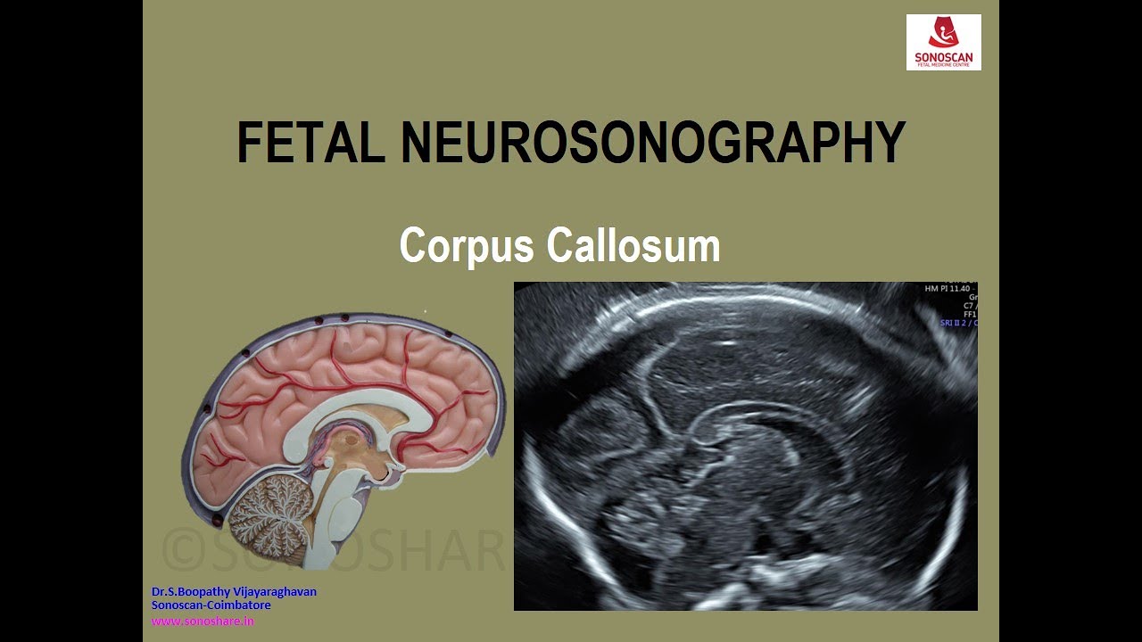 Fetal Neurosonography – Corpus Callosum