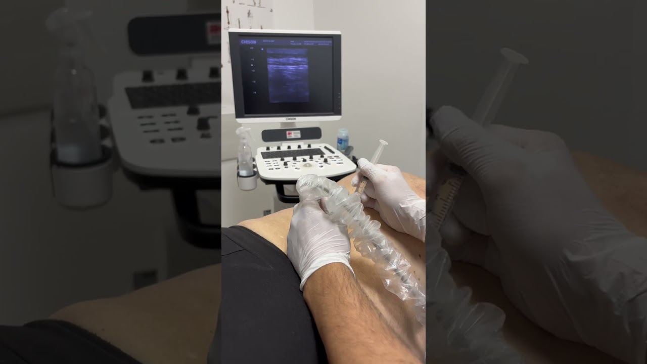 Фиброз мышц.Гидродиссекция под УЗ-навигацией.Miofibrosis.Ultrasound control hydrudissection