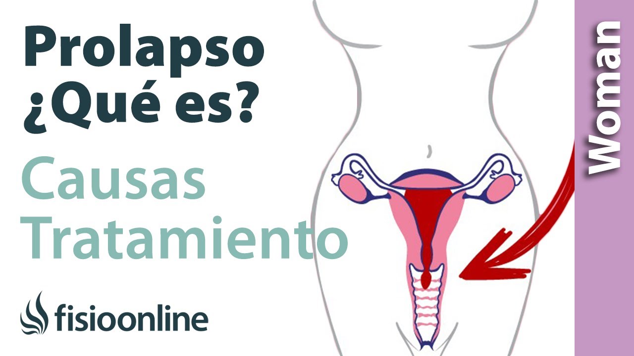 🚺Qué es un PROLAPSO, CAUSAS y TRATAMIENTO🤔