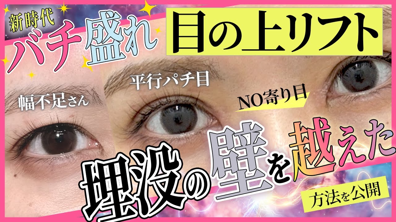 【NEW/目の上リフト】二重幅大幅UPの大革命！埋没二重・眉下切開整形の限界を超えた「目の上リフト」が登場【寄り目にならない平行二重づくり】湘南美容クリニック