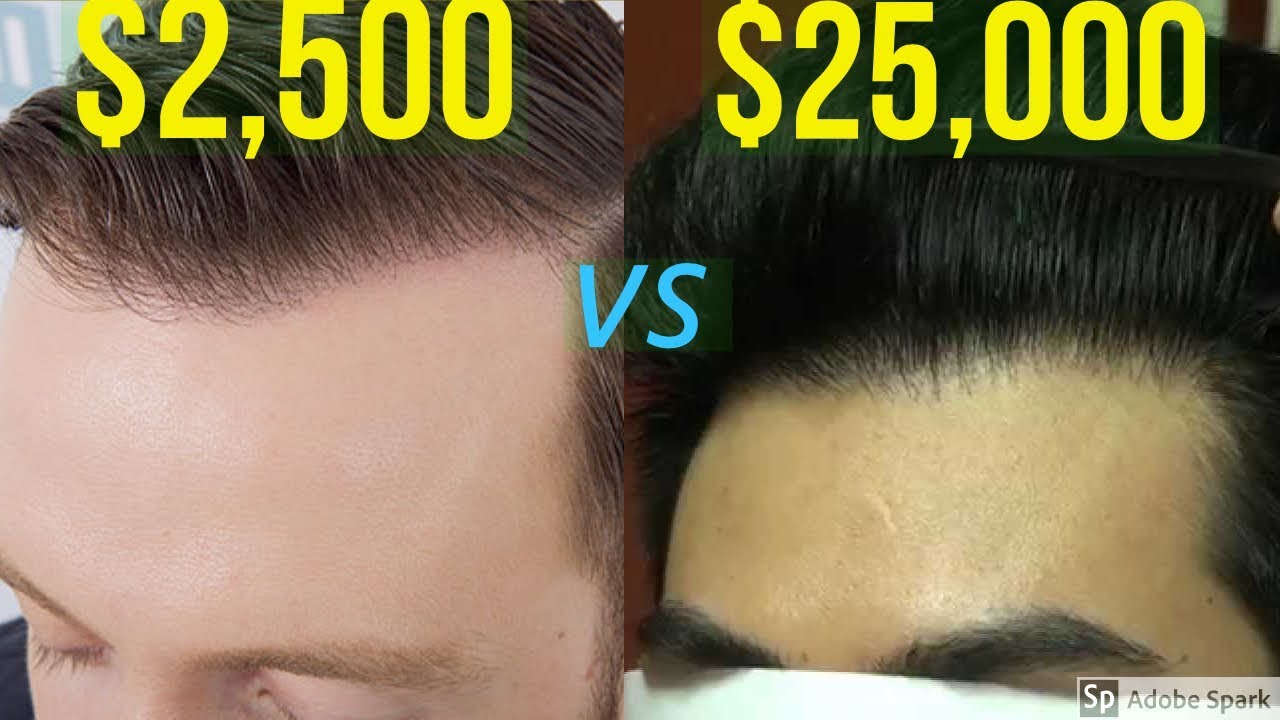 $2,500 HAIR TRANSPLANT VS $25,000 HAIR TRANSPLANT