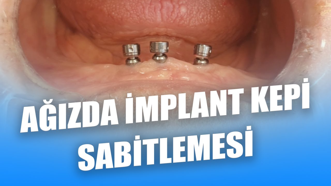 İmplant Destekli Hareketli Protezlerde Kepleri Ağız İçinde Sabitlemek