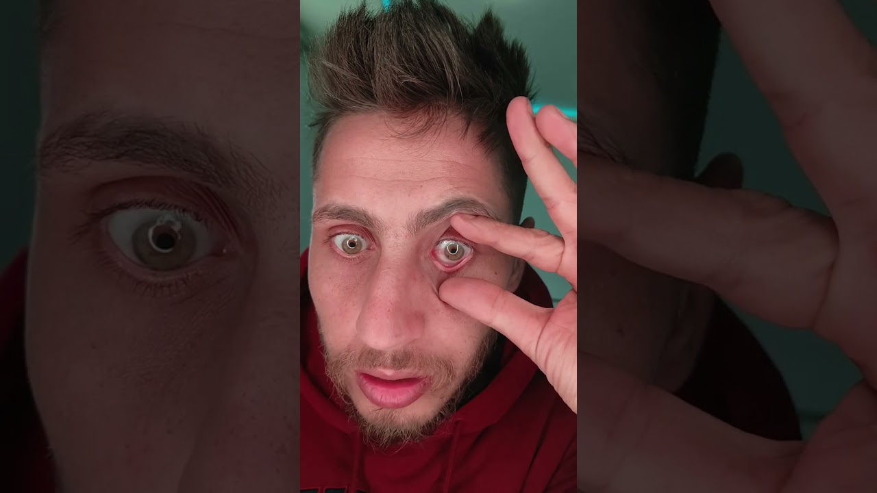 كيفية وضع العدسات اللاصقة سكليرال comment faire les lentilles scleral