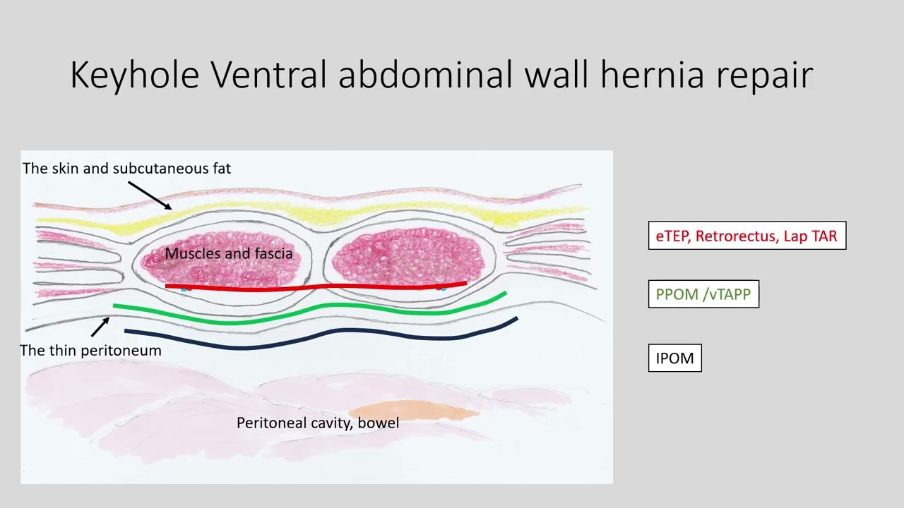 Ventral abdominal wall hernia, umbilical/incisional hernia, PPOM vTAPP eTEP Lap TAR techniques