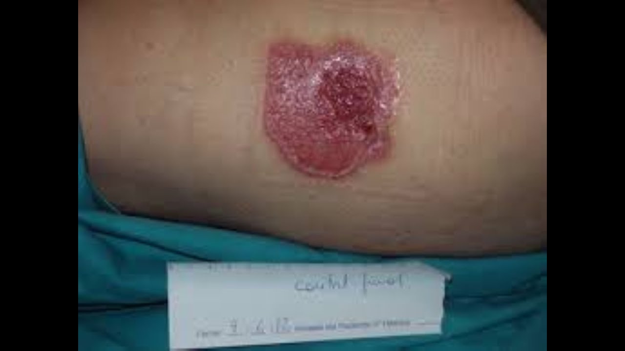 Wound Dressing