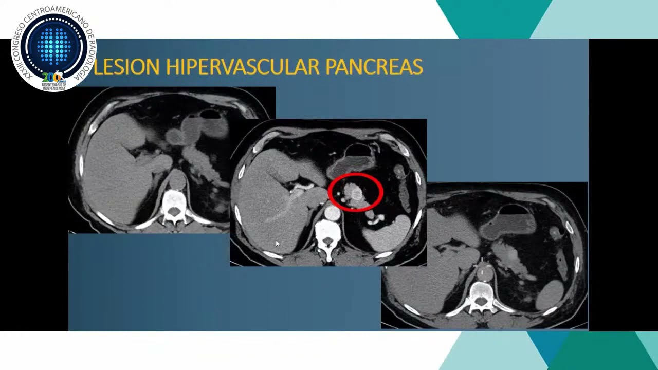 Tomografía trifásica para evaluación abdominal - Dr. Rodolfo Ibarra