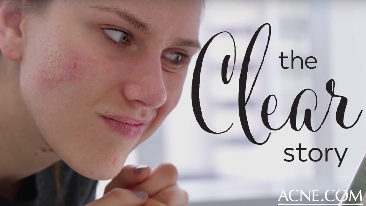 3 Ways To Stop Popping Pimples | The Clear Story
