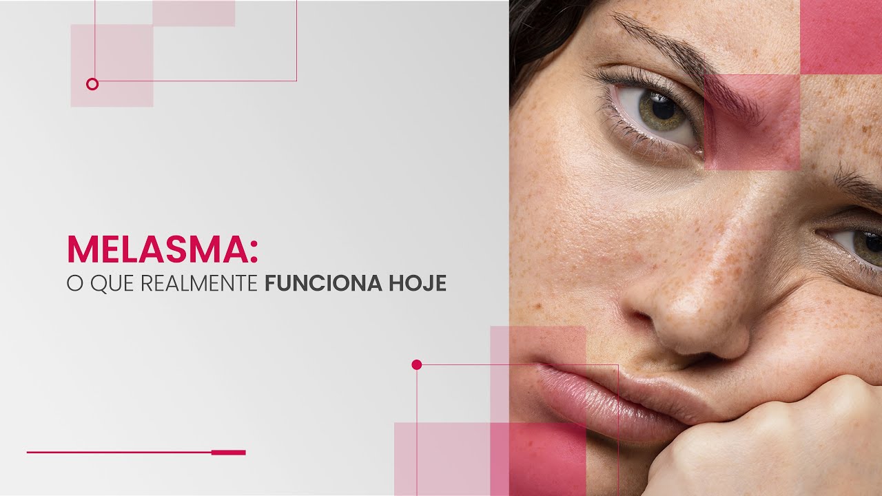Melasma: O que realmente funciona hoje?