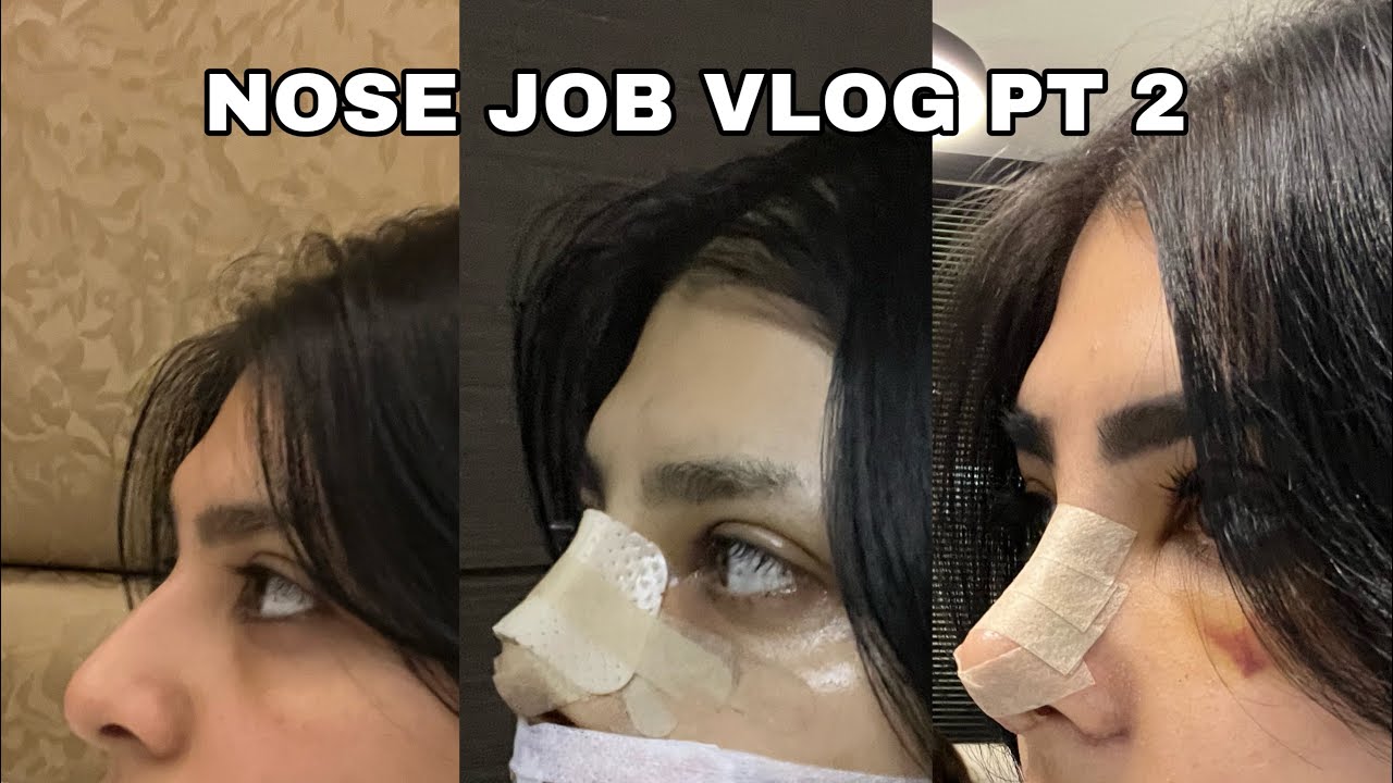 AFTER GETTING MY NEW NOSE IN TURKEY - PART 2 | CLINICHUB & DR SAMIL SAHIN
