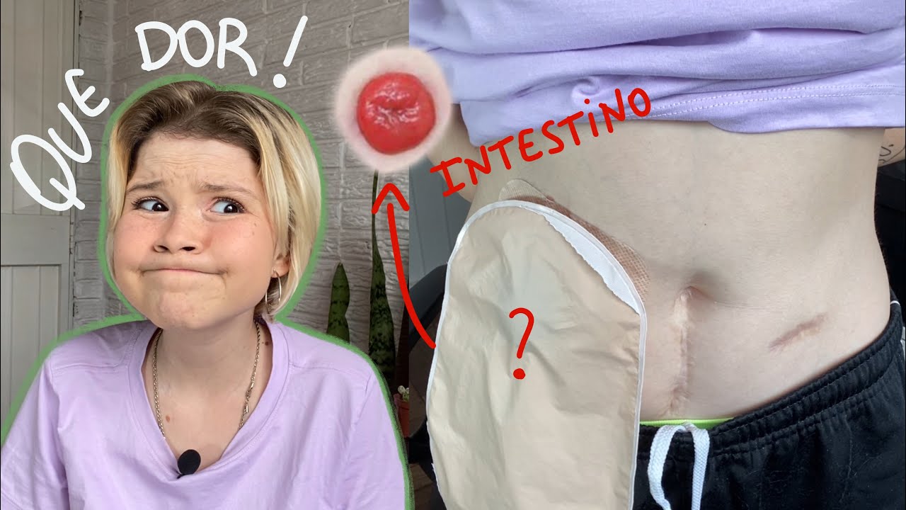 TER COLOSTOMIA DÓI ? Como é ter uma parte do intestino para fora ?