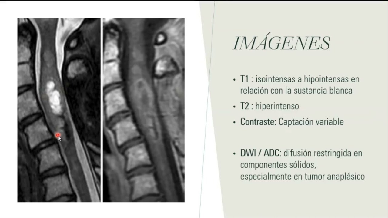 Ependimomas Medulares. Dr Daniel Apolinar