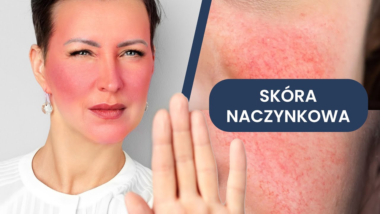 Jak pielęgnować skórę naczynkową? 47 kosmetyków + Schematy pielęgnacji dla SKÓRY NACZYNIOWEJ