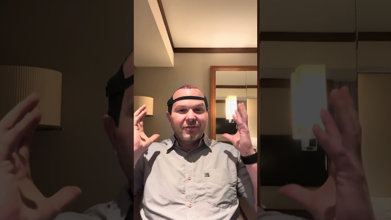 Vera Clinic Hair Transplant Experience and Review - Summer 2025