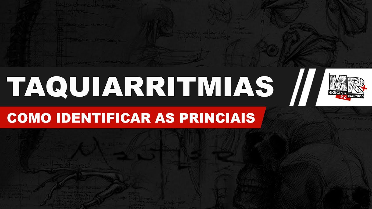 Taquiarritmias - Como identificar os principais ritmos na prática?