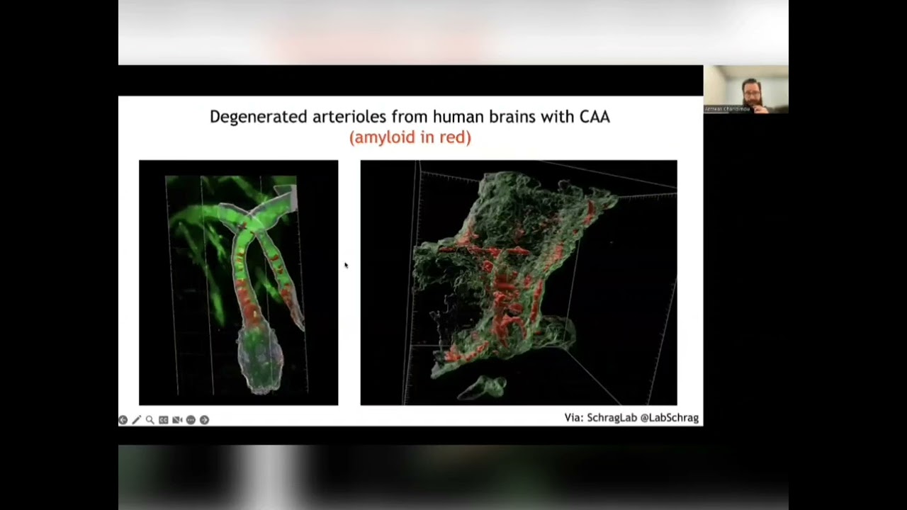 Updates in Cerebral Amyloid angiopathy