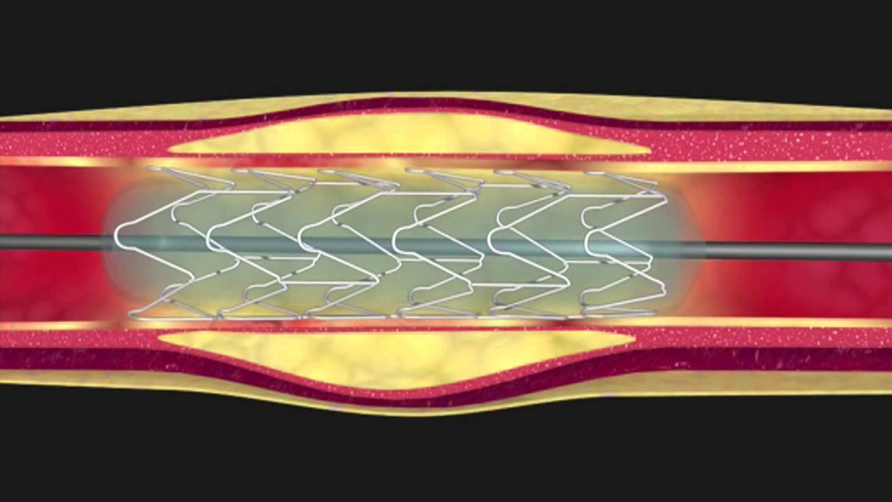 L'angioplastie coronaire