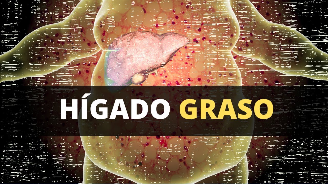 Hígado graso - lo que debes de saber (diagnóstico, síntomas, tratamiento y prevención)