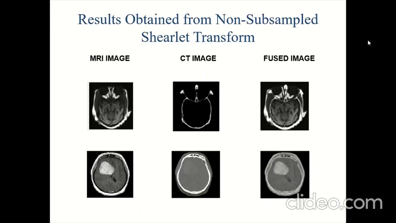 Multimodal Medical Image Fusion using Non-Sub Sampled Shearlet Transform